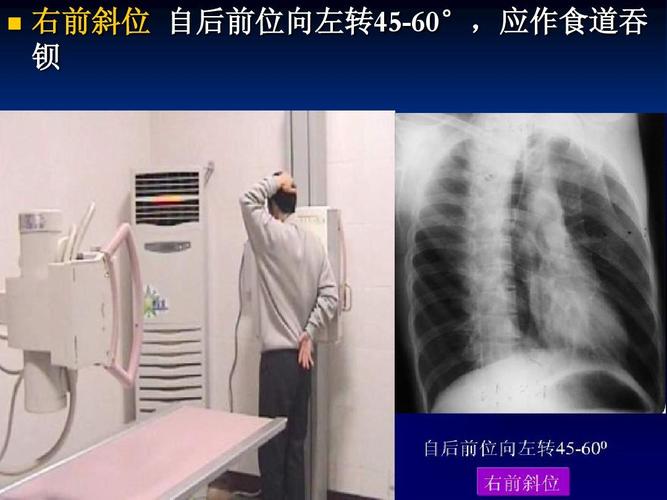 右前斜位 自后前位向左转45-60°,应作食道吞 钡