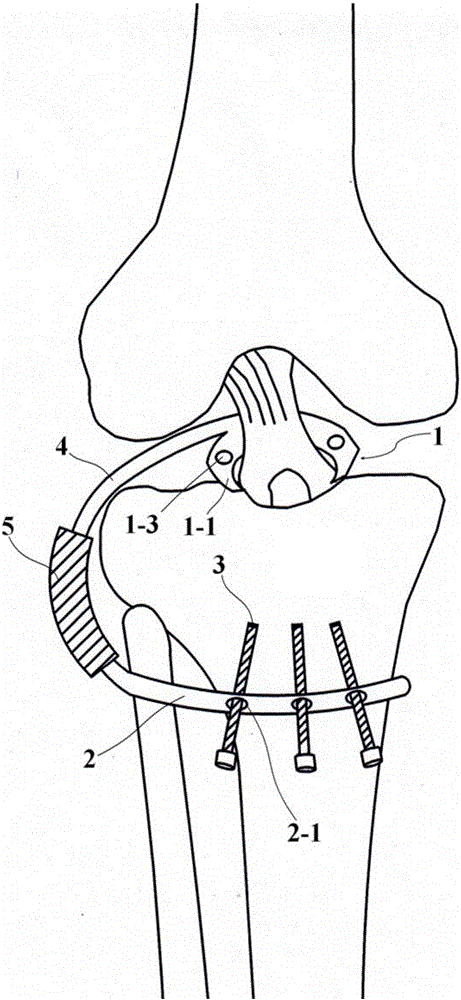 专利名称一种微创胫骨髁间嵴骨折复位固定导向装置的制造方法
