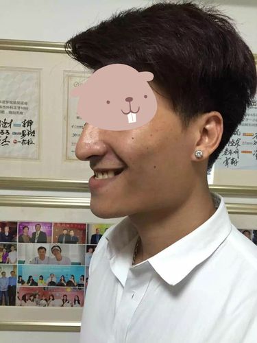 地包天正颌手术前后图片对比