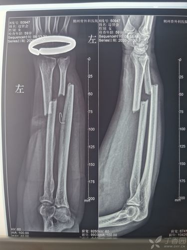 左尺桡骨双骨折钢板固定