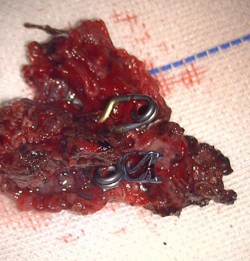 切除的畸形血管团