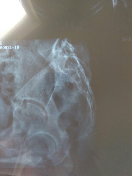 尾骨疼了三四个月了,按压不痛,躺着,走路,弯腰都不痛,只有坐着痛,尤其