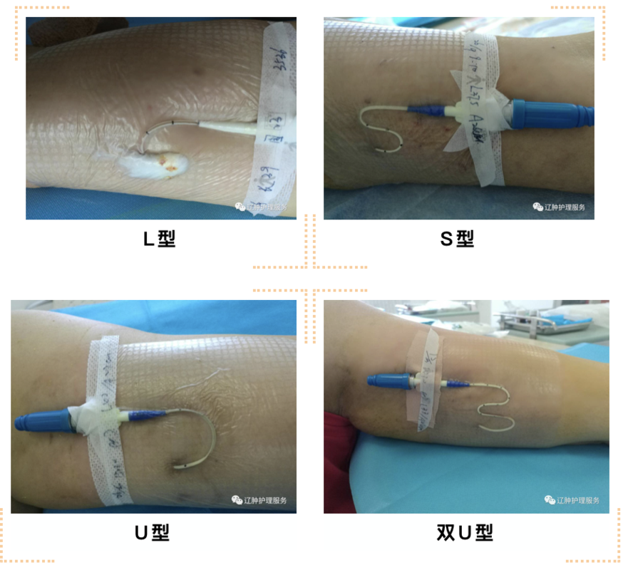 如何正确固定picc导管外露部分?