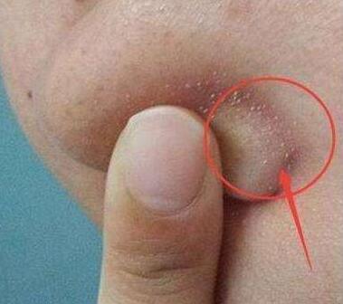 鼻子上的"米粒"越来越多,多是"它"在惹事,三招帮你解决