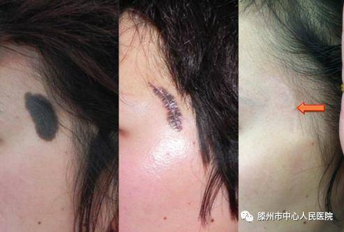 左颞部巨大黑毛痣患者,分期切除病灶并使用本文报道方法缝合治疗效果