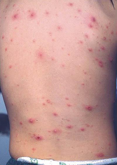 看图识病系列 水痘