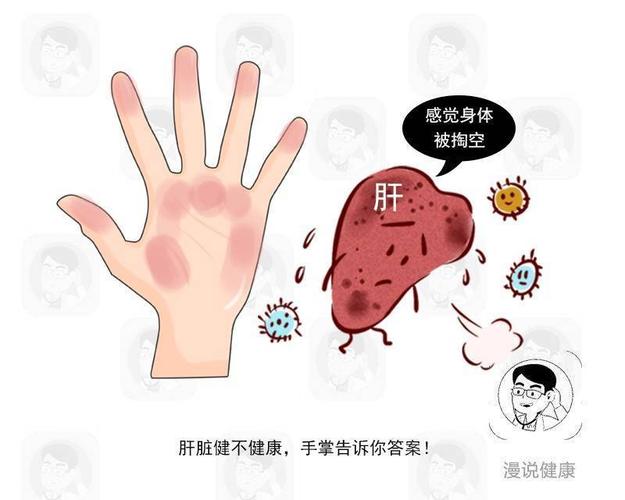 乙肝患者主要会有以下几个症状: 1, 浑身乏力:乙肝患者早期可出现不同