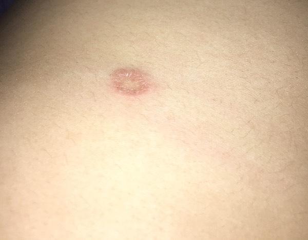 四周发红 中间白是什么皮肤病