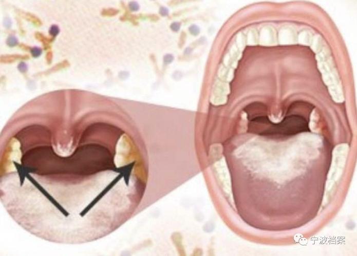 儿童白喉症状图片