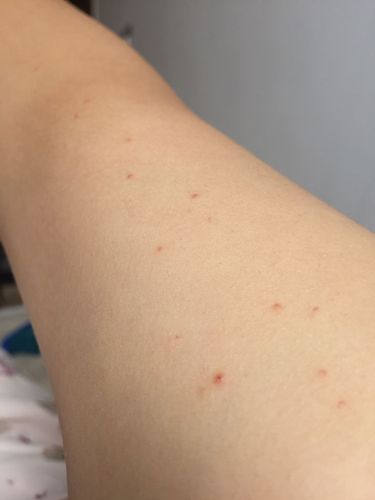 胳膊上起了几个小红点,不知道是什么,基本不疼不痒,偶尔会有点痒,能有