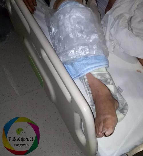 经医院检查,该名男子腿部粉碎性骨折,目前已手术,正在接受治疗,车祸