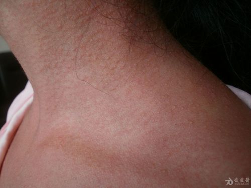 典型病例分享:猩红热.