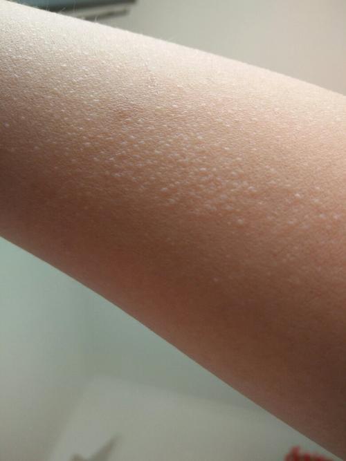 跟老公去水上乐园 然后回家胳膊上有小白点 而且痒痒