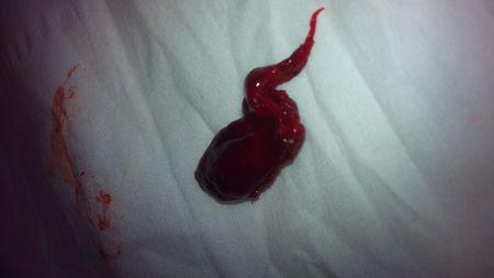 这是一个两个多月的胚胎