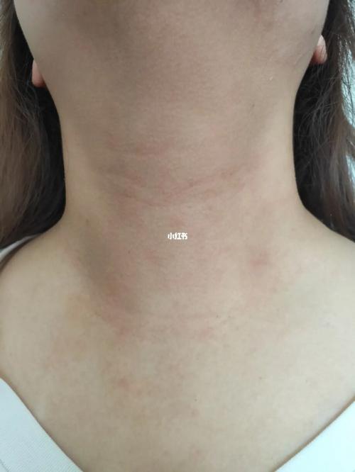 求助,脖子痒_皮肤过敏_过敏_皮炎_医疗健康_医疗健康