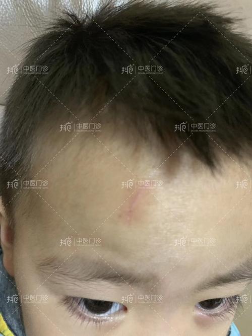 抖疤:案例分享(手术缝合伤疤案例)