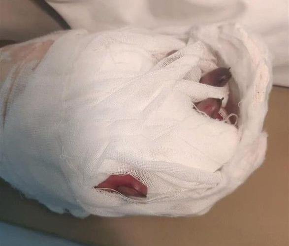 一辈子毁了!19岁学生遭"强制实习"致残:2根手指惨遭截肢!