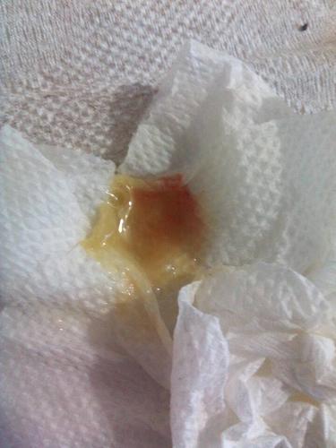 这是不是得了肺结核