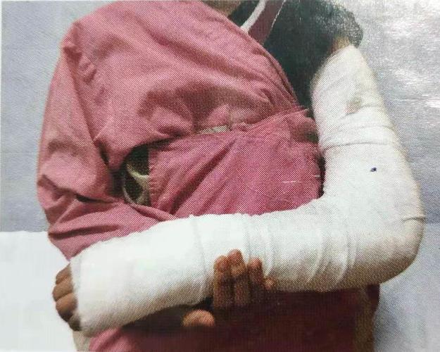 上肢损伤打石膏以后的注意事项