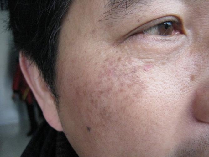  p>真皮斑(dermal spots)是位于皮肤真皮部位的 a target="_blank"