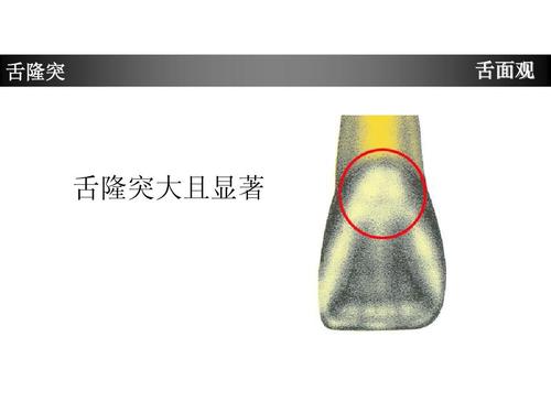 舌隆突 舌面观 舌隆突大且显著