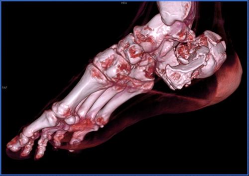 病例2,男,49岁,右足跟骨粉碎性骨折