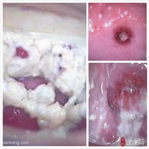 白带异常的症状豆腐渣