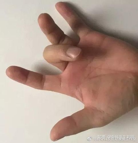 医生,我的手指疼伸不开了,是怎么回事?