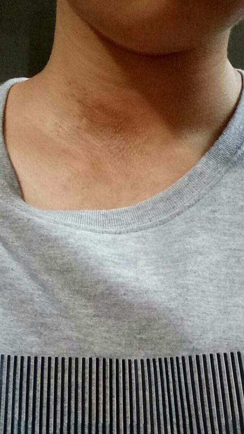 有一天闲的没事做,就在脖子上涂了除疤膏,就长了黑斑.