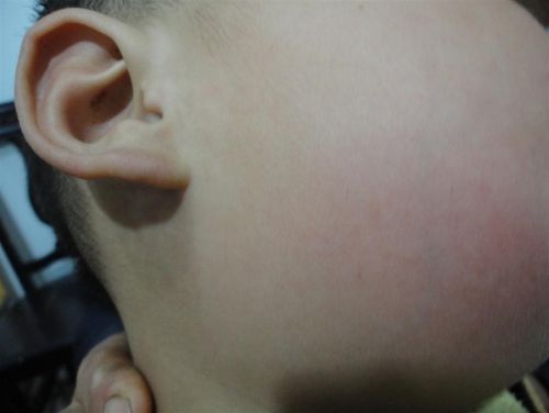 是淋巴结炎还是颌下腺炎,还是颌下腺炎合并颌下淋巴结