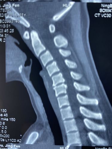 颈椎病的前路微创手术