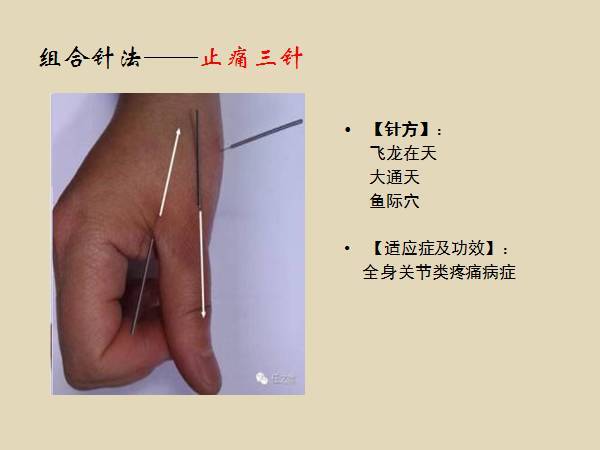 阴阳九针组合针法之——止痛三针