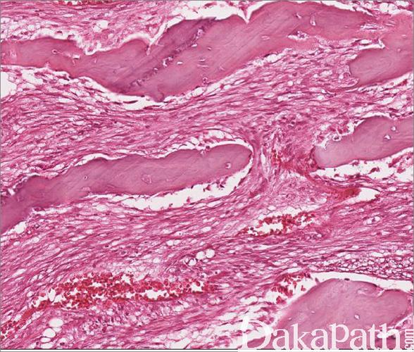 高分化髓内骨肉瘤