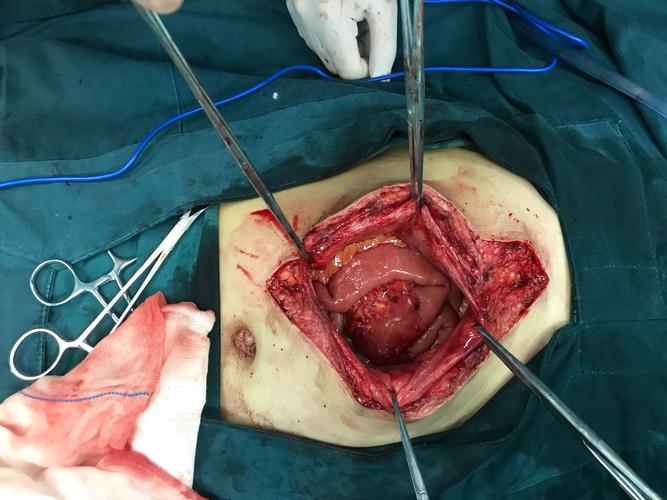 一位腹壁切口疝患者的故事