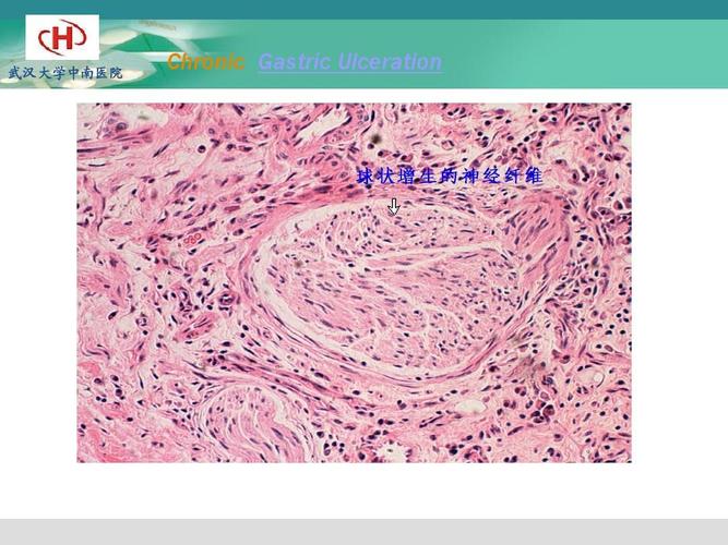 慢性萎缩性胃炎ppt