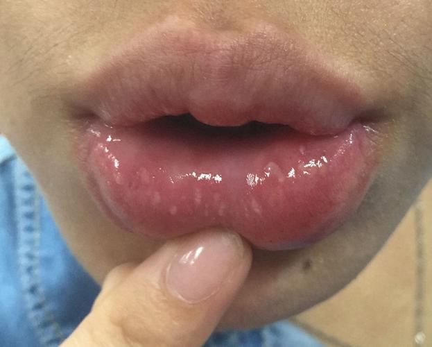 口唇单纯疱疹症状嘴角的图片_有来医生