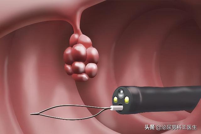 当然,如果严重到了一定的地步,需要通过手术切除癌症部分的直肠和肛门