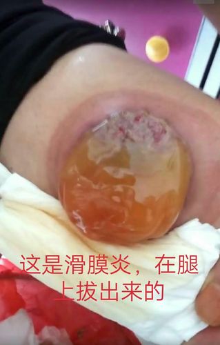 神奇的小拔罐,你值得拥有