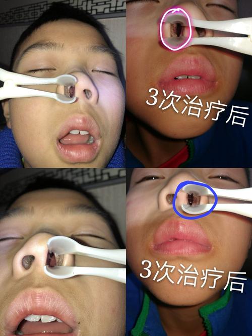 鼻甲肥大不重视,小心失去嗅觉!