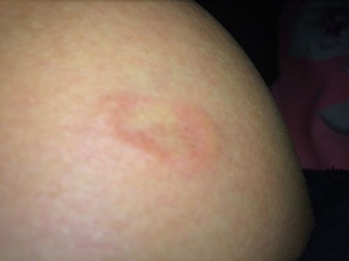 孕妇怀孕五个月,乳房上起了一圈小红疙瘩,很痒.请问这