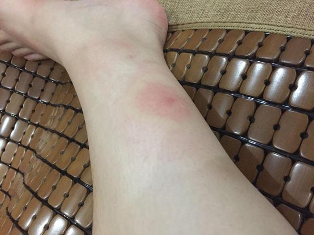 结核性溃疡患者,皮肤症状表现明显,多数患者不在意,尽量早检查