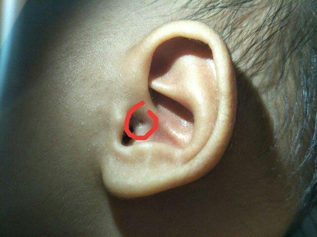 45天的宝宝耳朵里有个小洞不知道是什么?不知道影不影响健康?