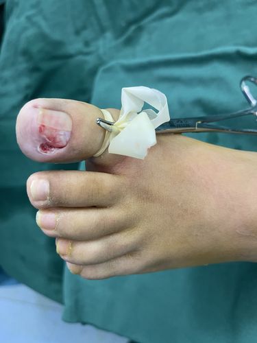 简单拔甲术后照片2)对于病史长,甲沟炎反复发作患者,可以采取甲床成型