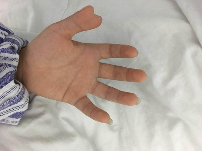 6岁男孩长出两个大拇指 医生顺利手术助其恢复自信