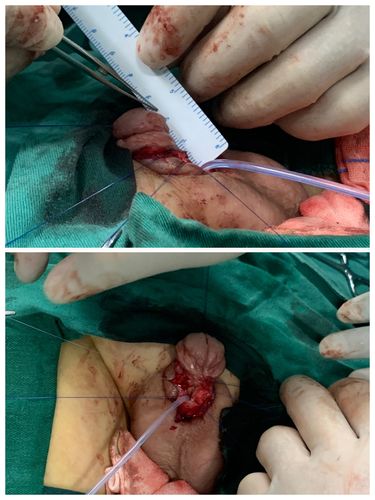 张家界市人民医院再次独立完成一例高难度尿道修复手术