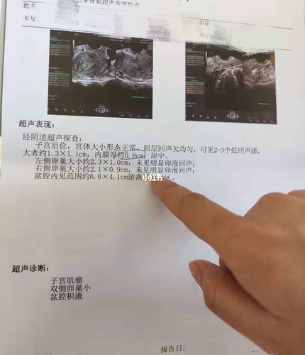 子宫肌瘤有哪些症状?结婚4年肚子3个球.