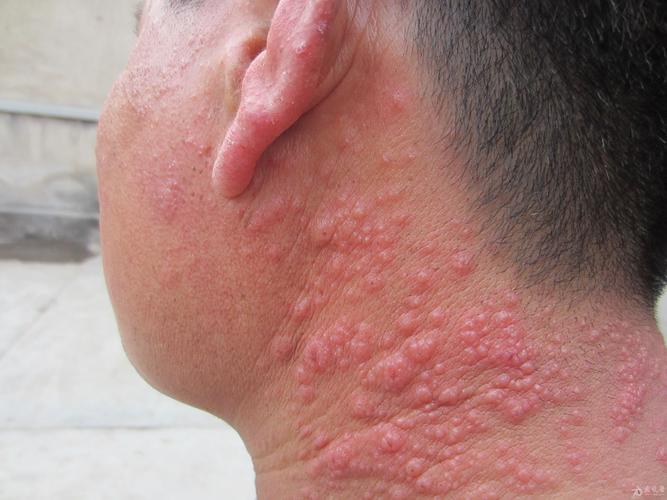 [病例讨论] 多形性日光疹