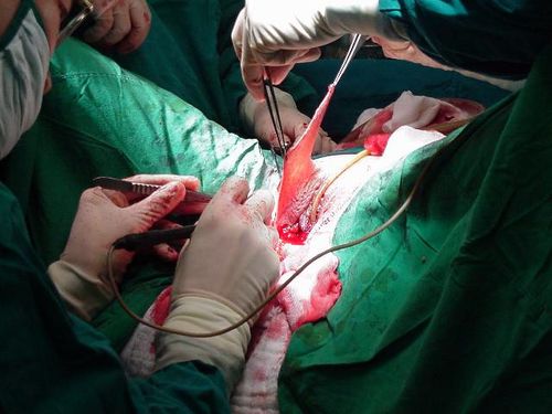 【转载】变性手术(男变女,血腥慎入)