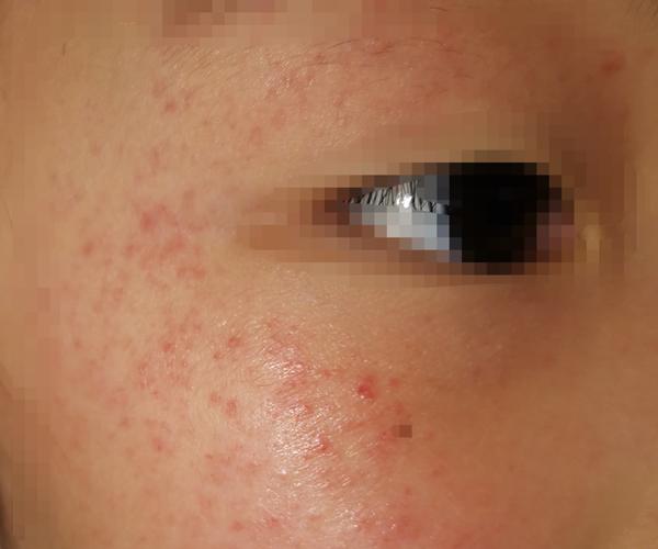 形形色色的紫癜和要命的出血点