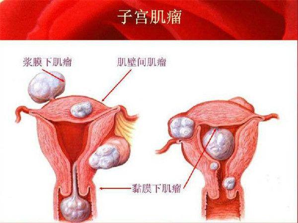 哪些子宫因素会影响试管婴儿移植成功率其中子宫畸形有哪些危害